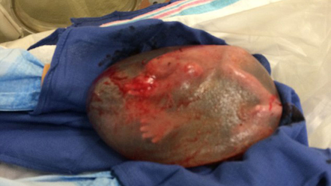 'Pixs from inside womb': Baby born in amniotic sac ...